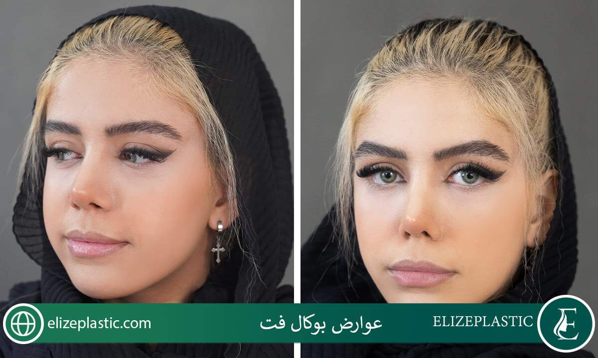  عوارض بوکال فت
